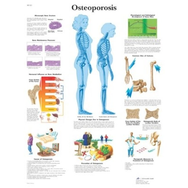 3B Scientific Anatomische Poster Osteoporose