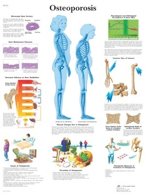 Anatomische Poster Osteoporose Vosmedisch Nl