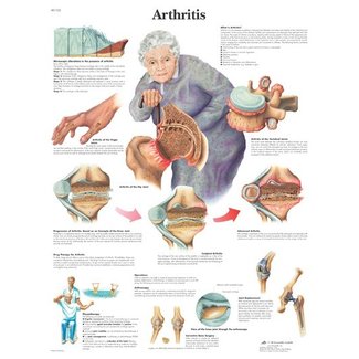 3B Scientific Anatomische Poster Artritis