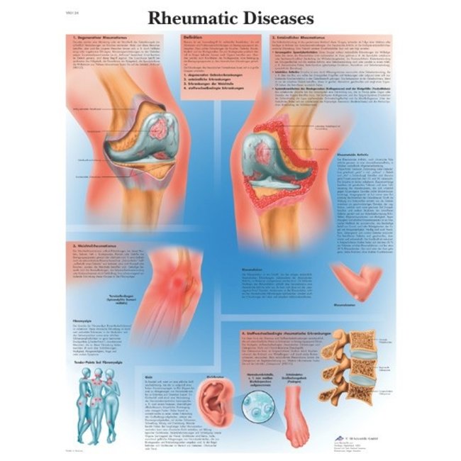 3B Scientific Anatomische Poster Rheumatic Diseases