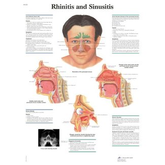 3B Scientific Anatomische Poster Rhinitis & Sinusitis