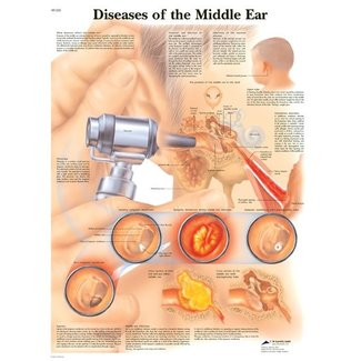 3B Scientific Anatomie Poster ziekten aan het middenoor - Engels/Latijn