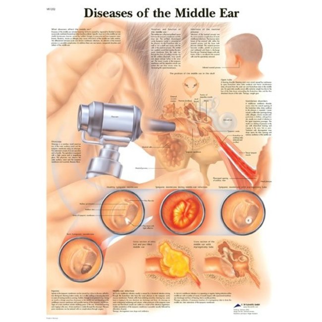 3B Scientific Anatomische Poster ziekten aan het middenoor/ Diseases of the Middle Ear - Engels/Latijn