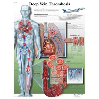 3B Scientific Anatomie Poster Trombose - Engels/Latijn