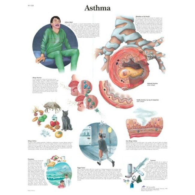 3B Scientific Anatomische Poster Astma