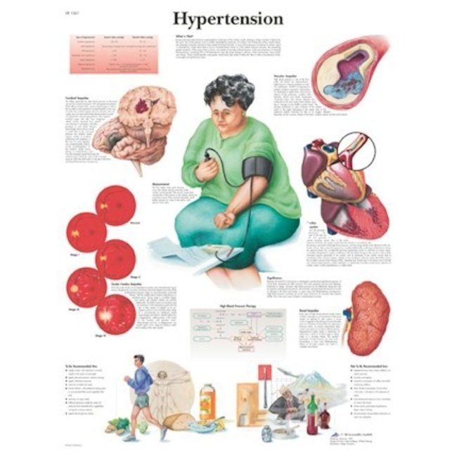3B Scientific Anatomische Poster Hypertention