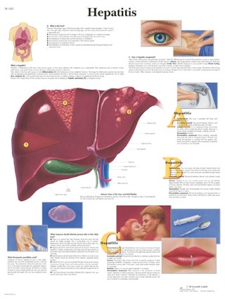 3B Scientific Anatomische Poster Hepatitis