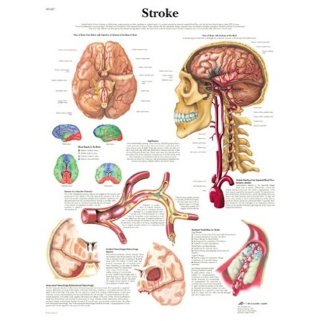 3B Scientific Anatomische Poster Stroke