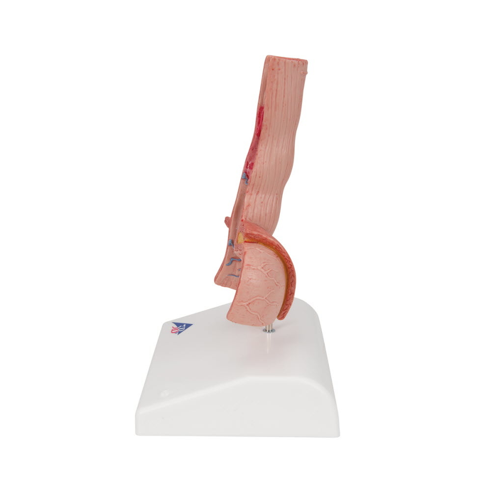 3B Scientific Anatomisch model Ziekten van de Slokdarm, foto 2 van 6