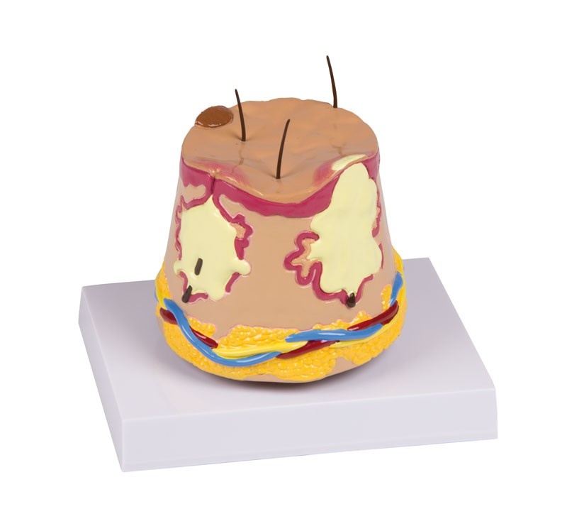 3B Scientific Anatomisch model van de huid met Acne, foto 2 van 4