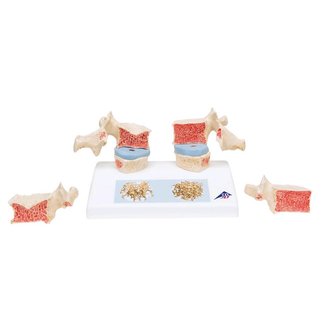 3B Scientific Osteoporosis model - 3B Scientific