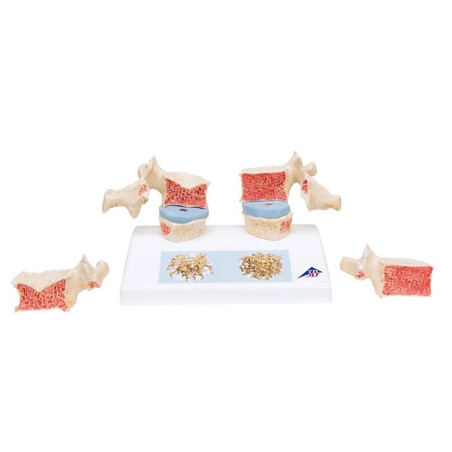 3B Scientific Osteoporosis model