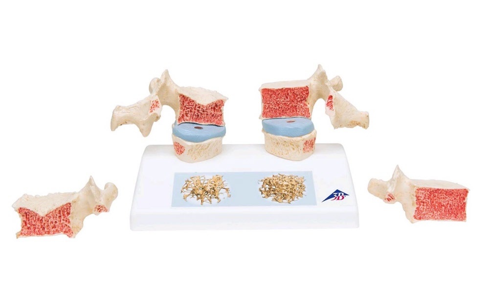 3B Scientific Osteoporosis model