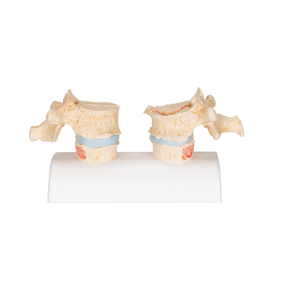 3B Scientific Osteoporosis model, foto 2 van 6