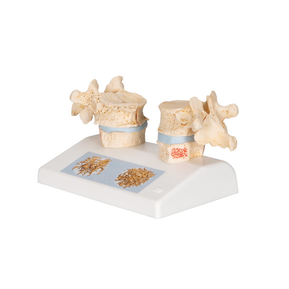 3B Scientific Osteoporosis model, foto 3 van 6