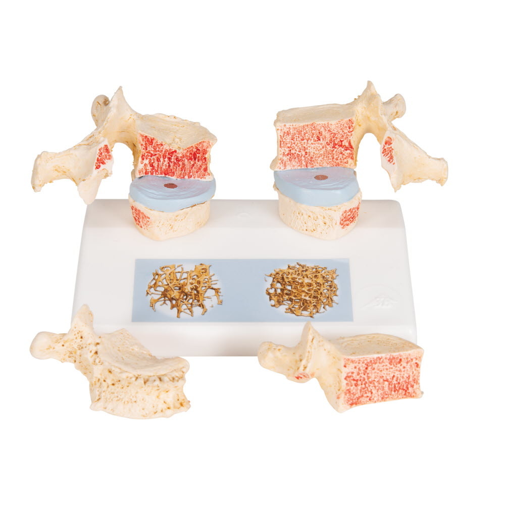 3B Scientific Osteoporosis model, foto 4 van 6