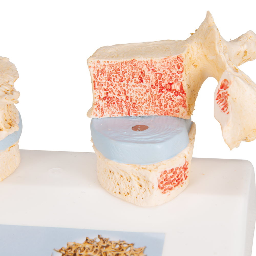3B Scientific Osteoporosis model, foto 5 van 6