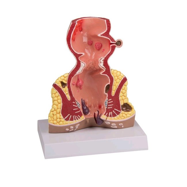 Anatomisch model van de rectum, doorsnede 1,5 maal vergroot