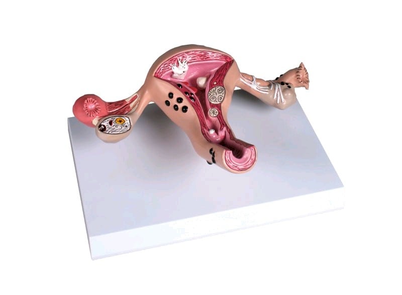Anatomisch model van de baarmoeder met ziekten - Vosmedisch.nl - A. Vos