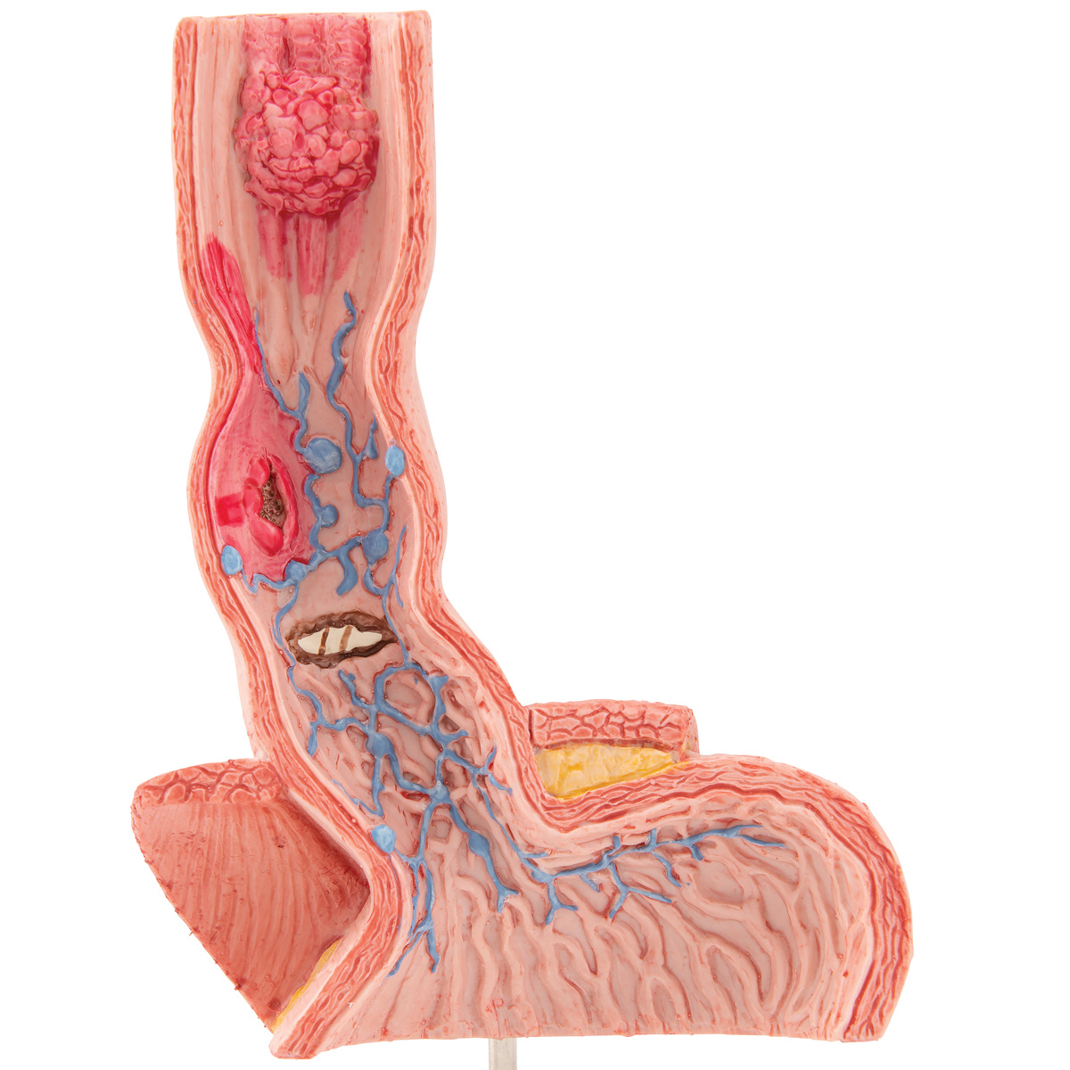 3B Scientific Anatomisch model Ziekten van de Slokdarm, foto 4 van 6