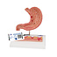3B Scientific Anatomisch model van de Maag met maagzweren