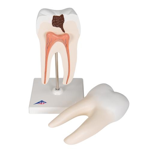 3B Scientific Anatomisch model van een dubbele wortel kies met cariës - 3B Scientific, foto 2 van 6