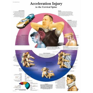 3B Poster Whiplash - acceleratie-deceleratie Trauma WAD | Engelstalig 3B Poster Whiplash - acceleratie-deceleratie Trauma WAD | Engelstalig