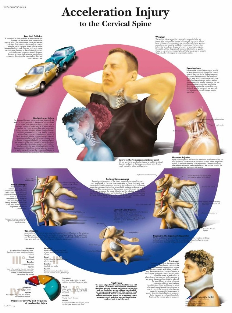 3B Poster Whiplash - acceleratie-deceleratie Trauma WAD | Engelstalig