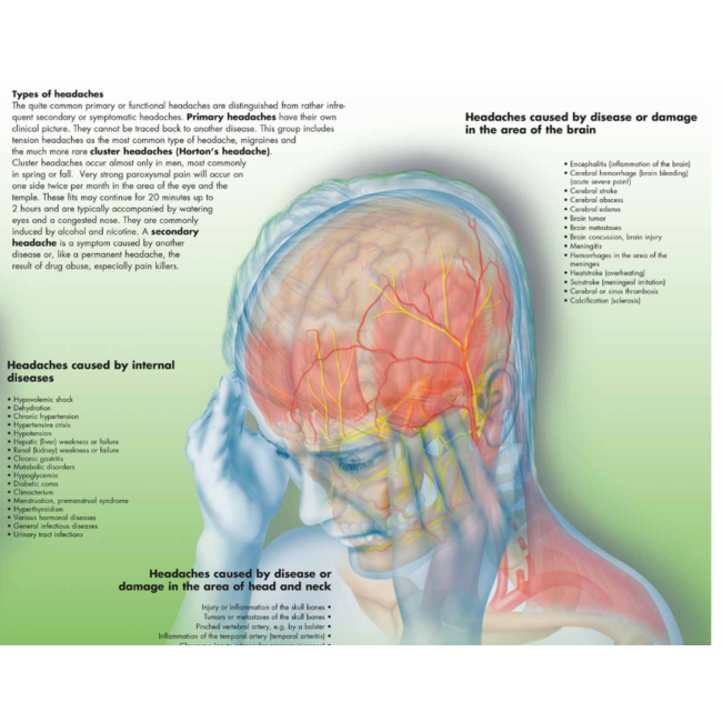 3B Poster Hoofdpijn / Migraine | Engelstalig