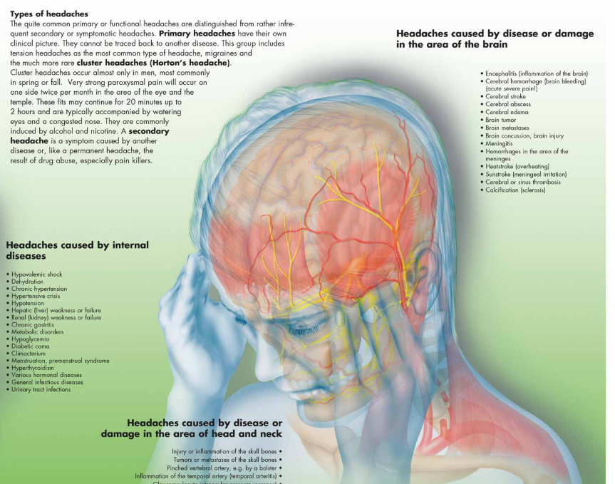 3B Poster Hoofdpijn / Migraine | Engelstalig, foto 2 van 2