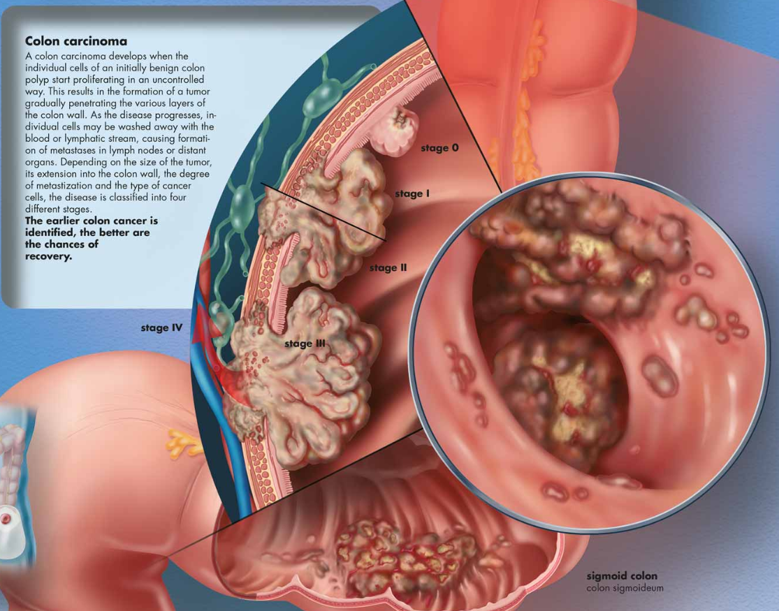 3B Anatomie poster | darmkanker | Engelstalig, foto 2 van 2