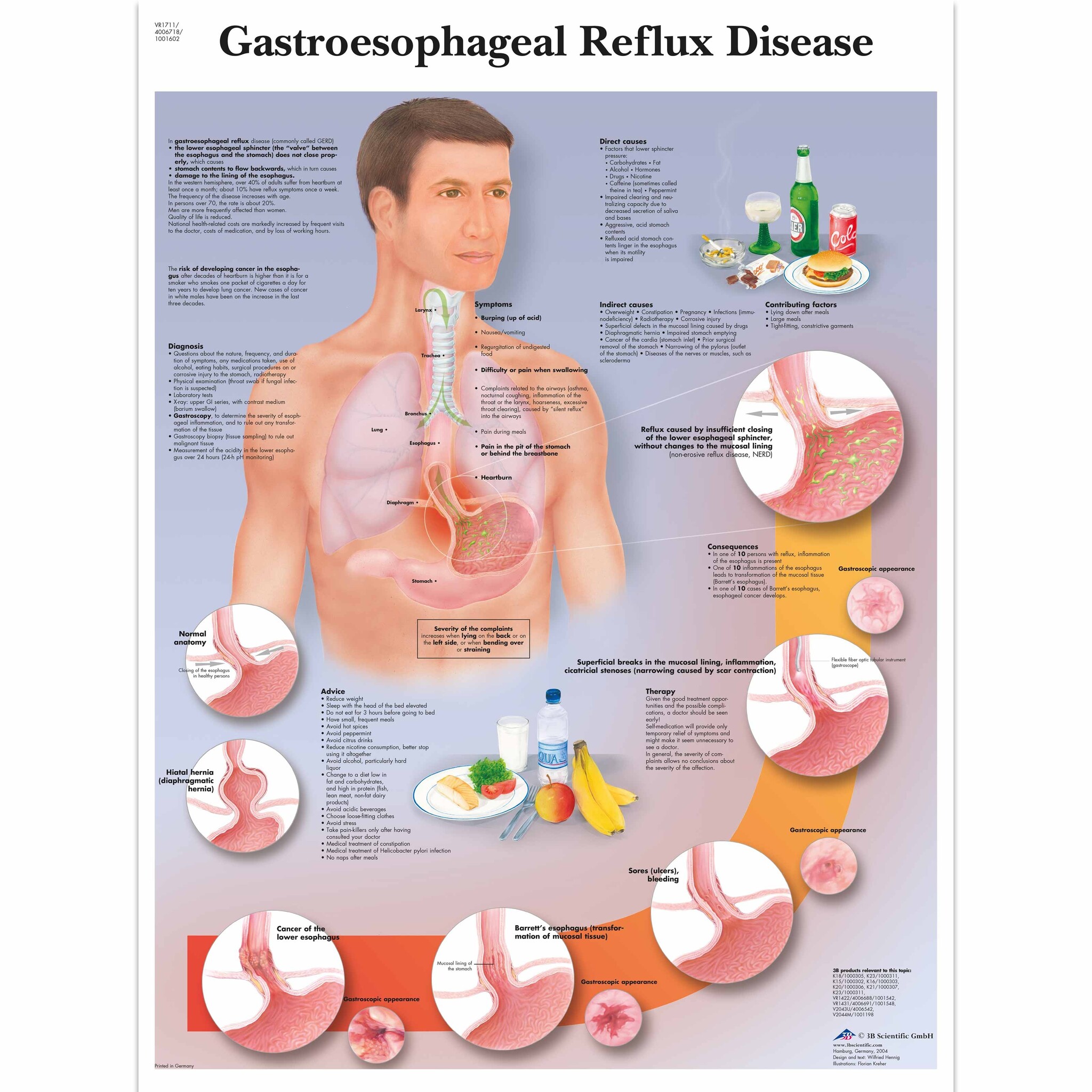 3B Poster - Gastro-oesofageale refluxziekte (GERD) | Engelstalig