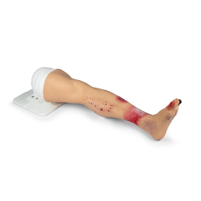 "Lena Leg" - Been met medische aandoeningen"