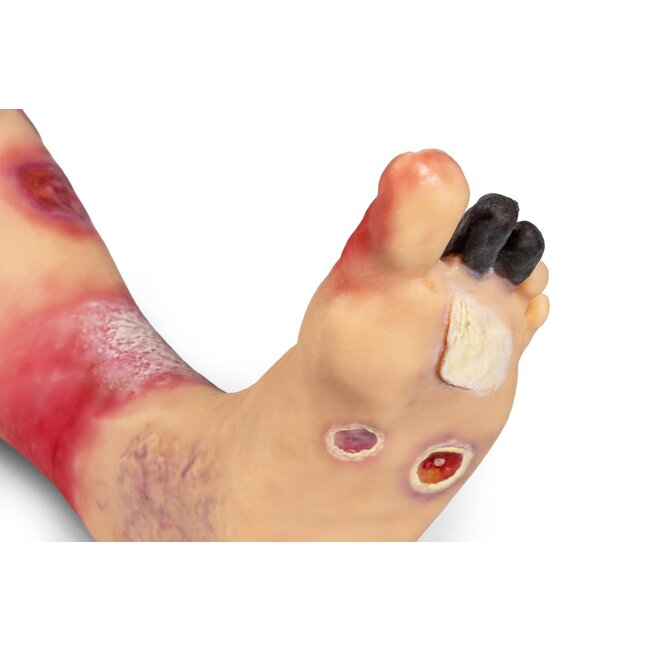 "Lena Leg" - Been met medische aandoeningen"
