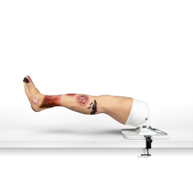 "Lena Leg" - Been met medische aandoeningen"