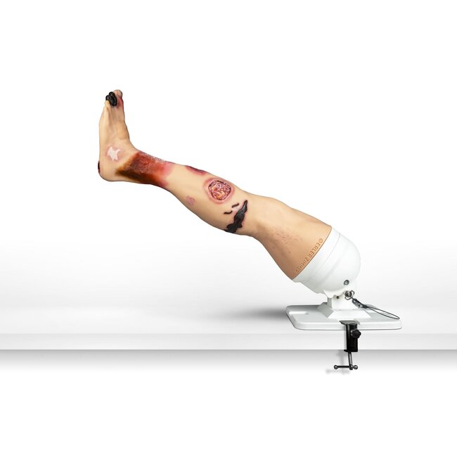 "Lena Leg" - Been met medische aandoeningen"