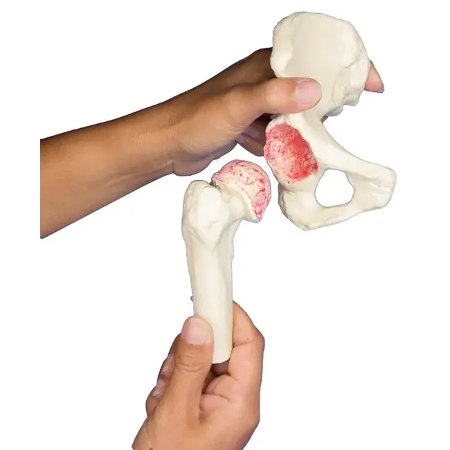 Erler Zimmer Heupimplantaat - Heupprothesemodel