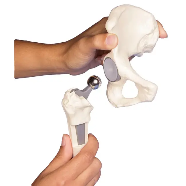 Erler Zimmer Heupimplantaat - Heupprothesemodel