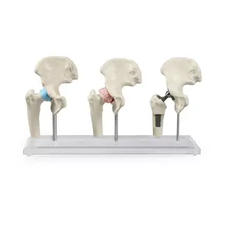 Erler Zimmer Heupimplantaat - Heupprothesemodel
