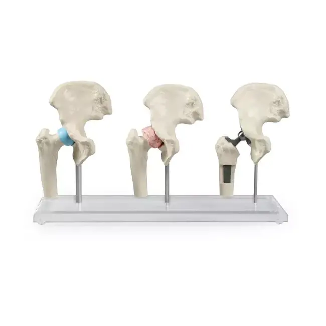 Erler Zimmer Heupimplantaat - Heupprothesemodel