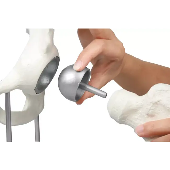 Erler Zimmer Heupgewricht met resurfacing implantaat