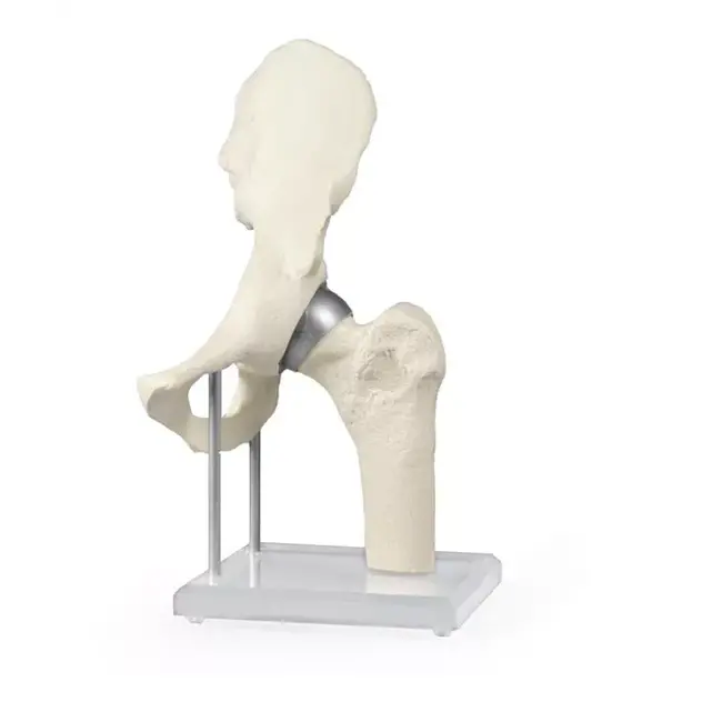 Erler Zimmer Heupgewricht met resurfacing implantaat