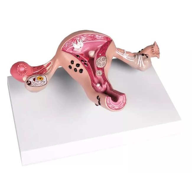 Erler Zimmer Anatomisch model van de baarmoeder met ziekten