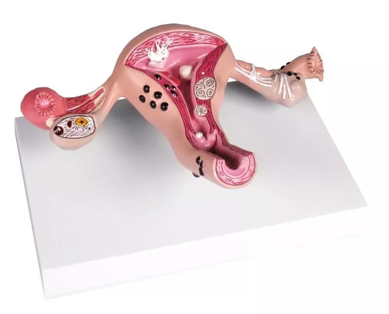 Erler Zimmer Anatomisch model van de baarmoeder met ziekten, foto 2 van 4