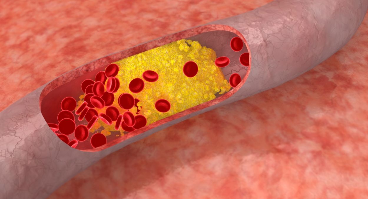 Alles wat je moet weten over cholesterol. Alles wat je moet weten over cholesterol.
