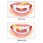 iDontix iDontix X-Flossthinner - 10 stuks