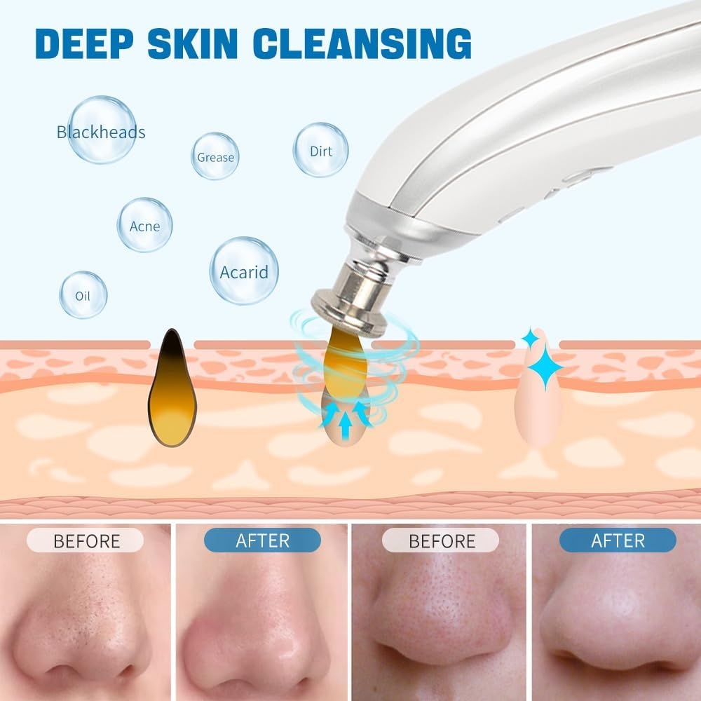 Microdermabrasie Apparaat: Reiniging & Peeling met Korting