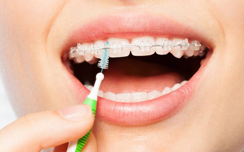 Mondverzorging met beugels: het belang ervan en praktische tips