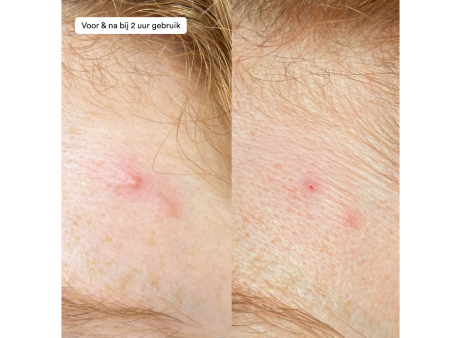 ray - pimple paste - acne prone skin