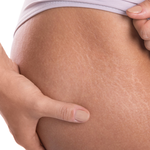 STRETCH MARK CONTROL